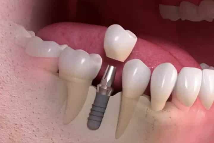 DENTAL IMPLANT 1