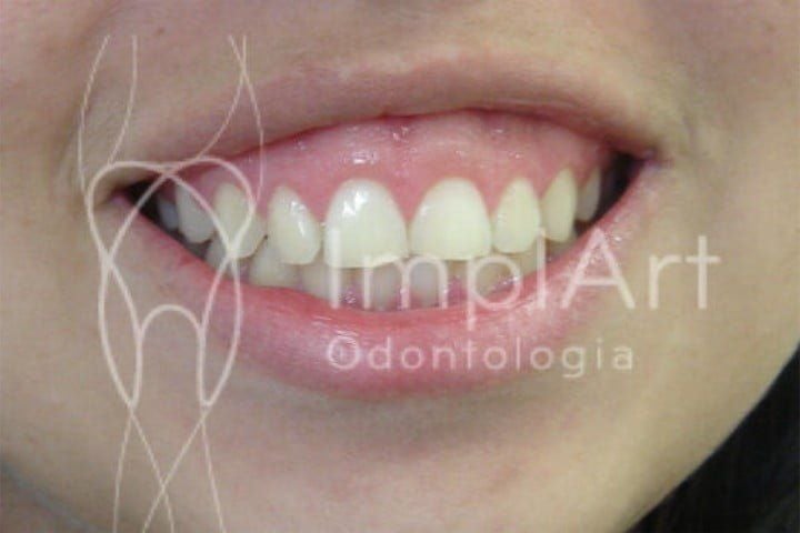 sorriso gengival tratamento 50kb d15e8611