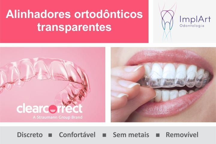 alinhador transparente clearcorrect straumann 50kb d6fa0a47