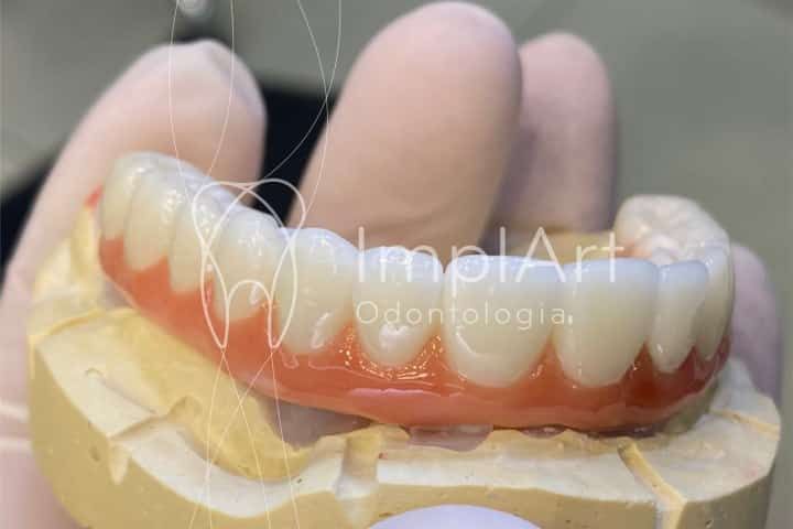 protese total zirconia superior para implantes 50kb d89c3fcb