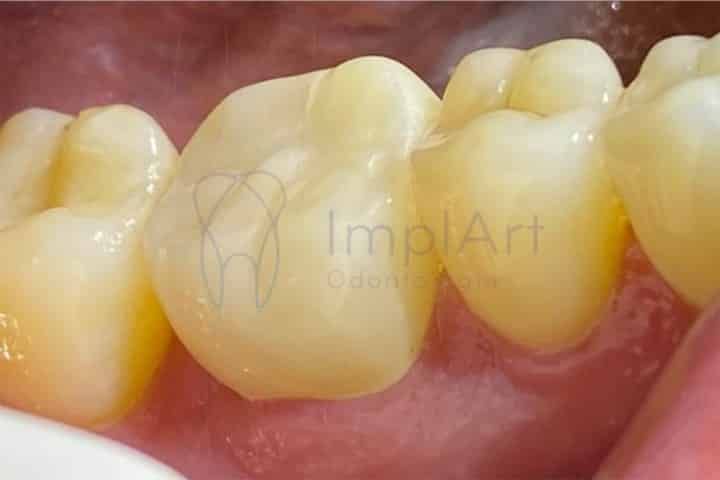 Coroa de zirconia para dente 50kb db3a0623