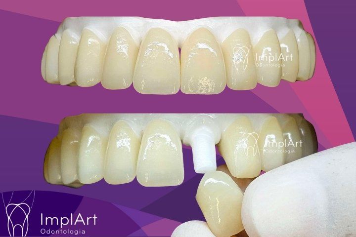 Fixed dentures with individualized separate teeth zirconia dentes individuais