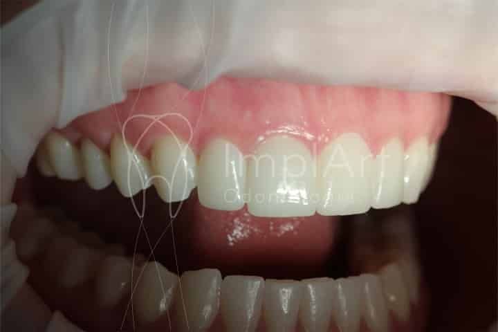 Lente contato dental 50 df444adb