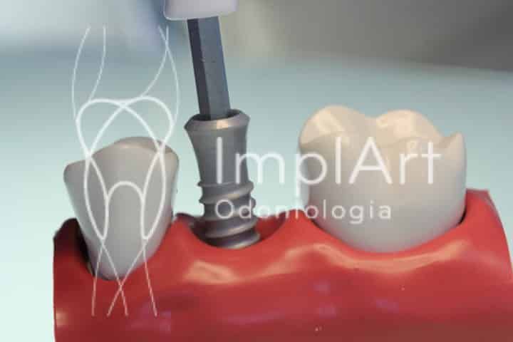 cirurgia de implante 50kb dfcf0c8f