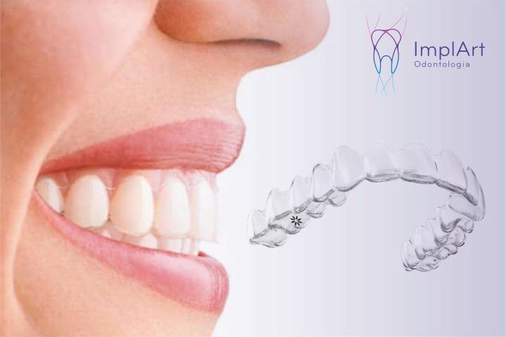 invisalign alinhador transparente 50kb df1f7b49