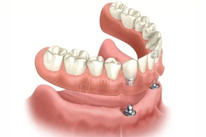 overdenture dentadura dois pinos 50kb e1bce34f