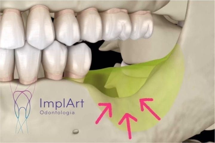 implante dentario de um dente para evitar perda óssea