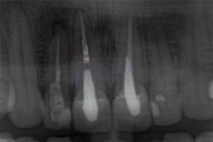 tratamento de canal radiografia 50kb f0c49746