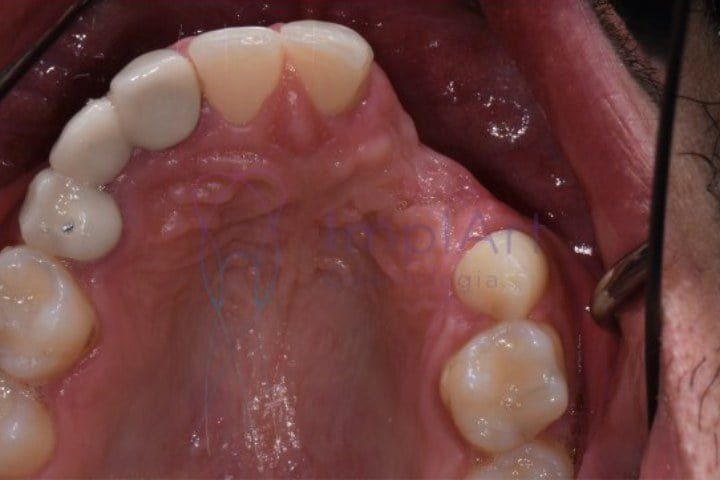 perda ossea falta dentes 50kb f2e85235