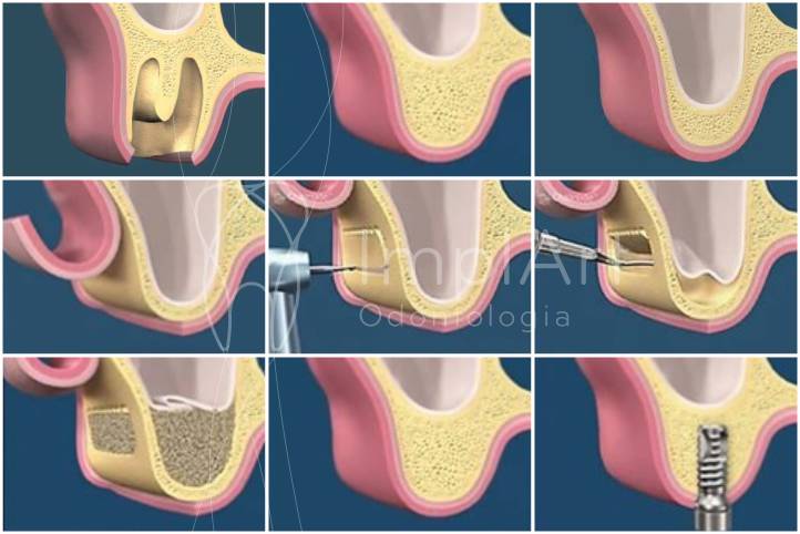 Enxerto ósseo levantamento do seio maxilar - sinus lift - ImplArt