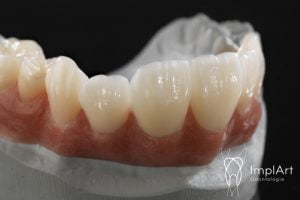 coroa de zirconia implante FX 50kb