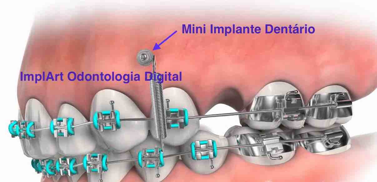 implante dentario mini Implante Dentário e Prótese Dentária ImplArt