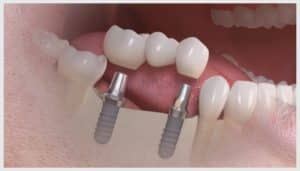 ponte sobre implantes glossy