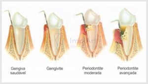 doenca periodontal fases glossy