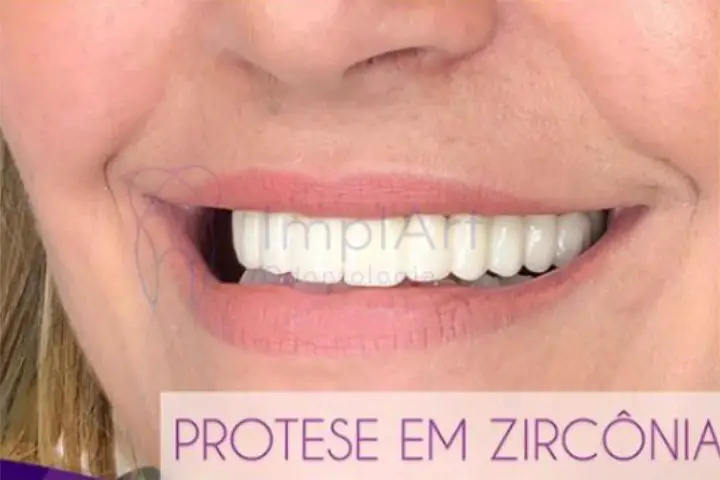 Preço E Valor De Implante Dentário E Prótese Dental Implart Quanto Custa 2869