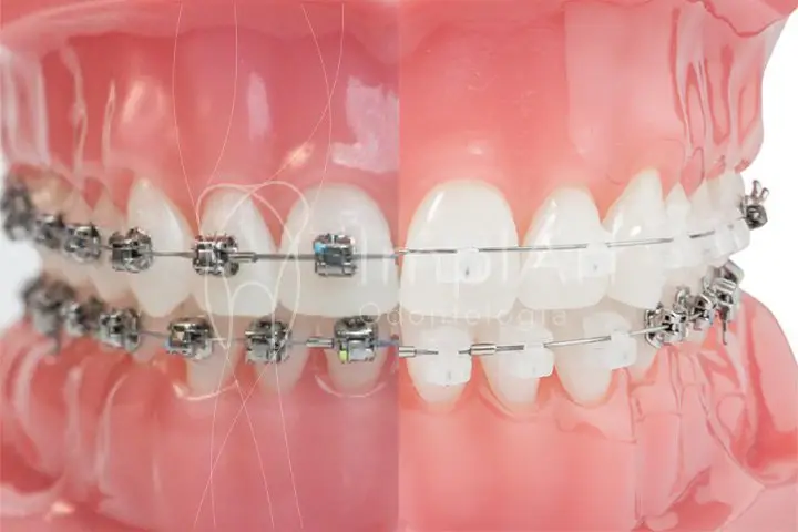 Ortodontia em Campinas  Aparelho Dentário Fixo ou Transparente