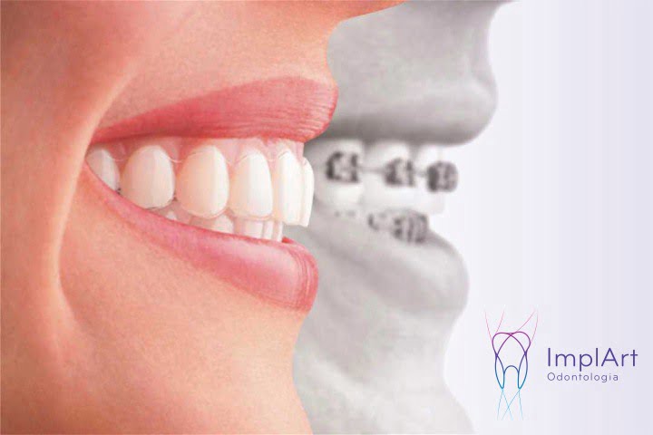 Invisalign Brasil - O tratamento Invisalign permite que sua higiene bucal  seja simples e eficaz. Seu dia a dia não muda. www.invisalign.com.br