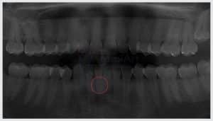 fratura raiz dentaria 40kb