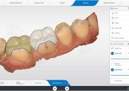 projeto computadorizado do tratamento odontológico prótese computadorizada