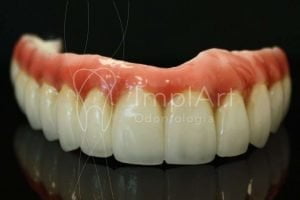 protese total fixa implantes metaloceramica 48kb