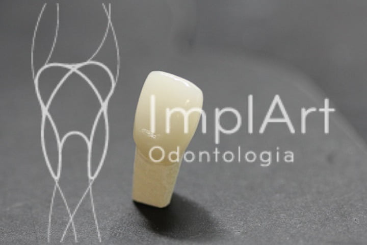 Coroaporcelana49kb Implante Dentário E Prótese Dentária ‿ Implart 7605