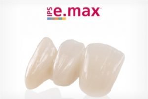 coroas ceramica emax 50kb