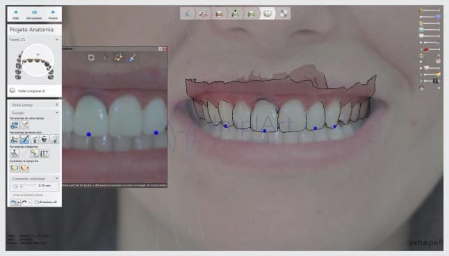 planejamento digital do sorriso odontologia digital resultados previsíveis Implante Dentário e