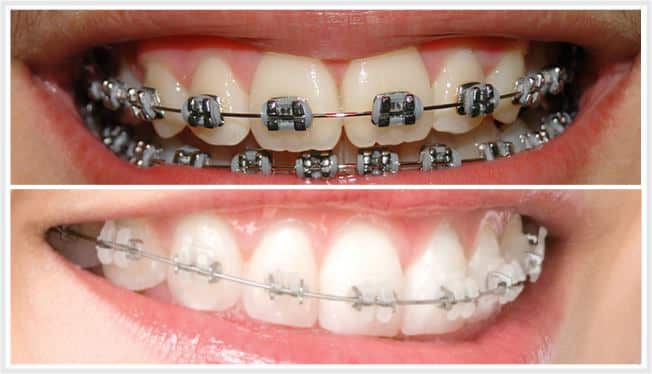 Ortodontia tratamento para corrigir os dentes Implante Dentário e Estética Dental ImplArt
