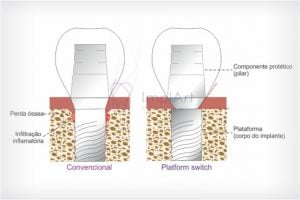 platform switch implants 50kb