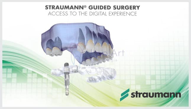 cirurgia guiada de implantes dentários