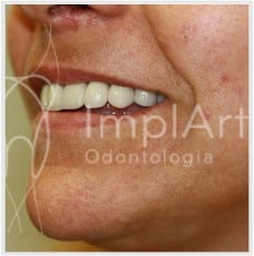 prótese dentária metalocerâmica metal+porcelana