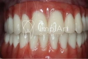 protese total fixa metaloplastica dentes importados 50kb