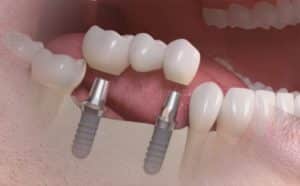 implante alguns dentes 400x248 25kb