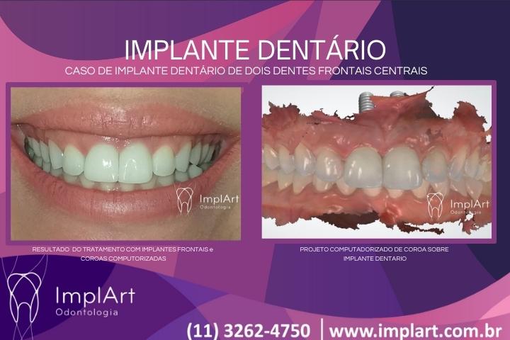 implante dentario frontal