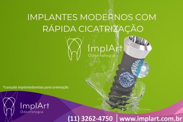 Modernos implantes dentarios com nanotecnologia disponíveis na ImplArt, considerada a melhor clinica de implante dentário de São Paulo