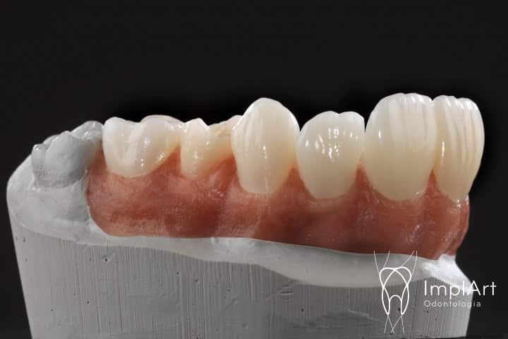 Próteses dentárias de um único molar projetadas por IA