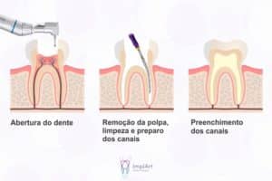 tratamento de canal ou implante dentario