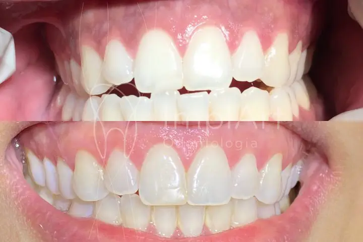 Ortodontia com Invisalign® – Migliore