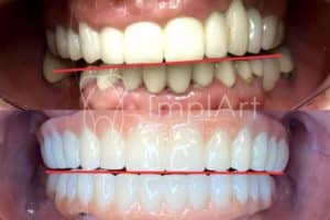 protese zirconia antes e depois 49kb