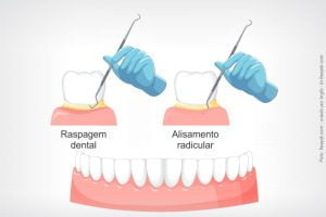 raspagem periodontal alisamento radicular 49kb