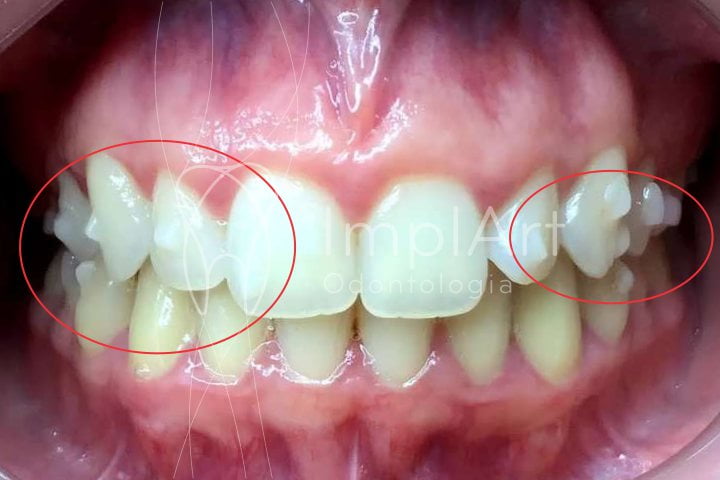 invisalign - implante dentário ImplArt