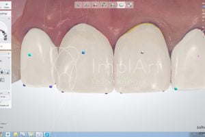 projetanto lentes dentais de porcelana 50kb