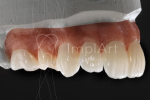 coroas zirconia multilayer 50kb