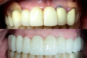 implante protese zirconia total antes e depois 50kb 1