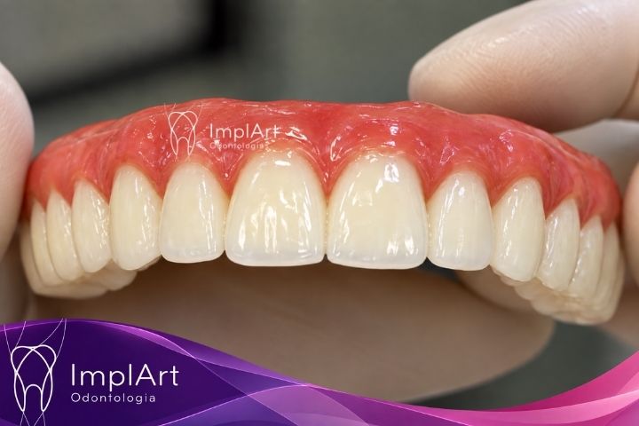 Prótese protocolo com implantes - tipos de materiais protese protocolo com implantes