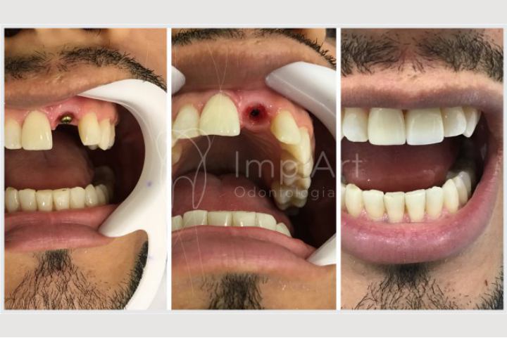 single tooth implant