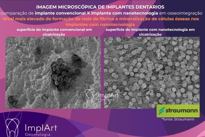 implantes com nanotecnologia