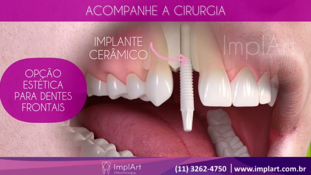 zirconia implant