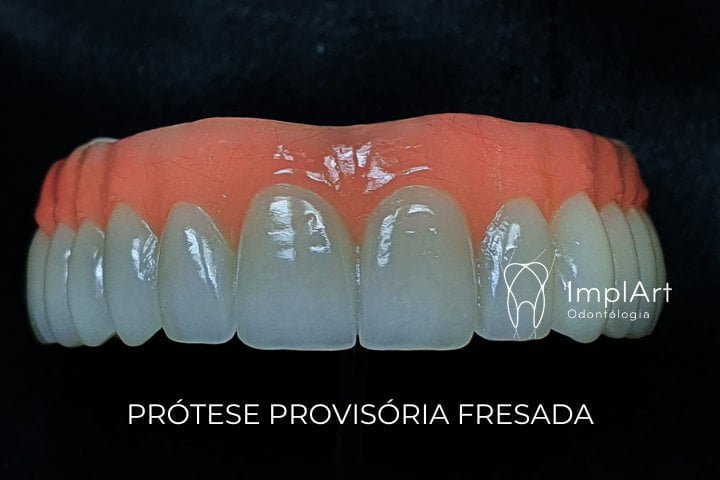 protese provisória para implante dentario