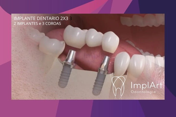 2X3 DENTAL IMPLANT